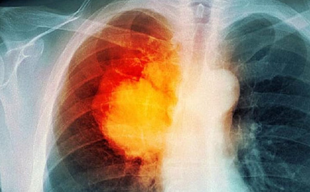 Mắc ung thư phổi: Tiên lượng sống và điều trị thế nào?