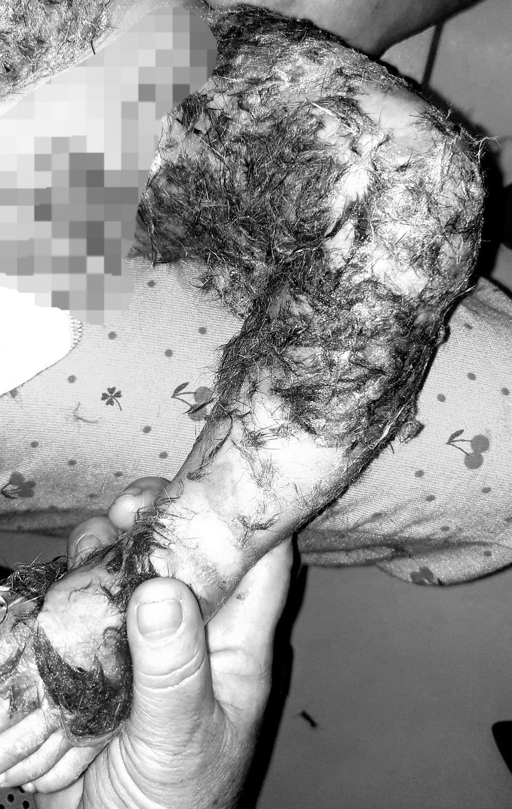 Thầy lang đắp lông chó để chữa vết bỏng từ ngực xuống chân cho bé 8 tháng tuổi - Ảnh 1.