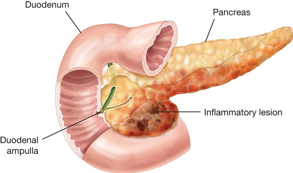 Đột ngột đau bụng, nôn: Dấu hiệu căn bệnh nguy hiểm đáng sợ ngày Tết - Ảnh 1.