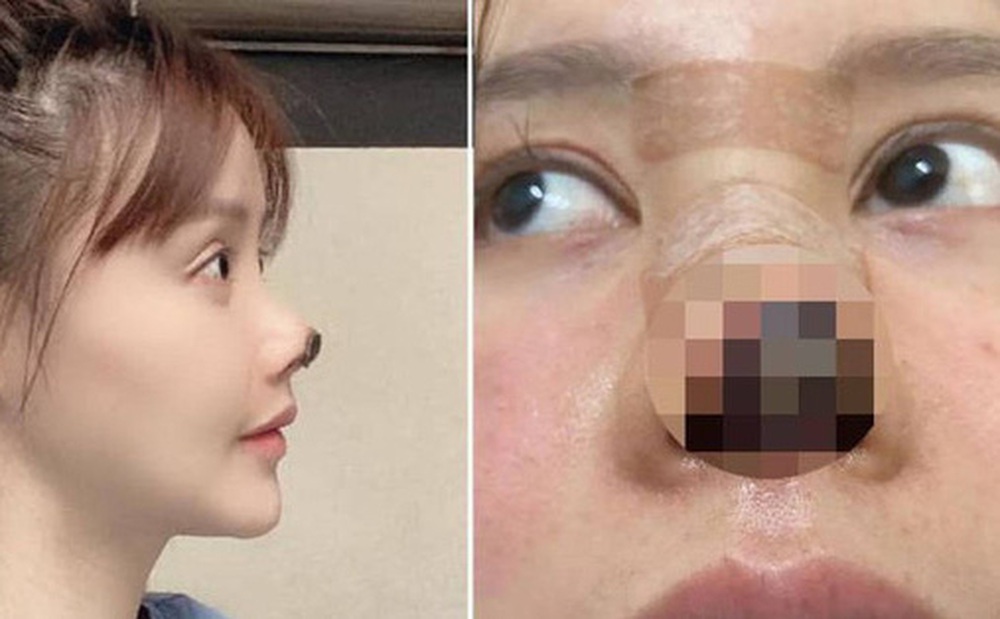 Nữ diễn viên Trung Quốc phẫu thuật thẩm mỹ tới nỗi rụng cả mũi, ngượng không dám thò mặt ra đường
