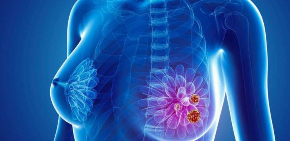 Bác sĩ tiết lộ vũ khí cứu hàng triệu người mắc ung thư vú: Giảm 40% tỉ lệ tái phát, 30% tỉ lệ tử vong - Ảnh 1.