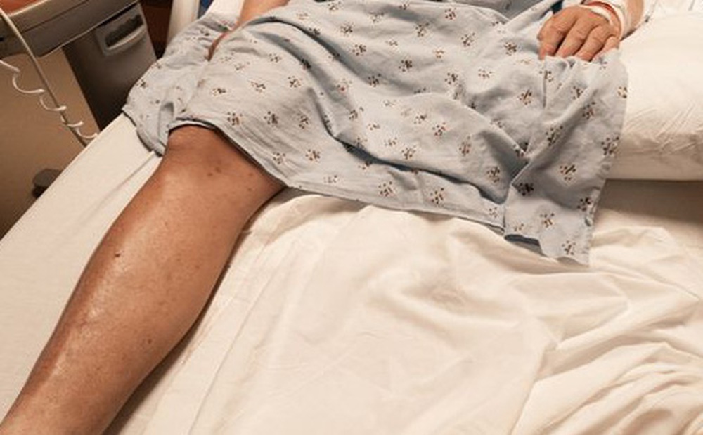 Bị bệnh cần phẫu thuật chân trái, cụ ông hoảng loạn khi biết bệnh viện cắt nhầm chân phải của mình