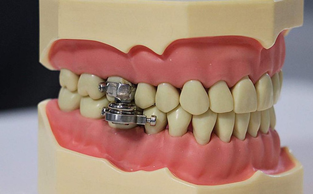 Thiết bị hỗ trợ giảm cân bằng cách 'khóa miệng' theo đúng nghĩa đen