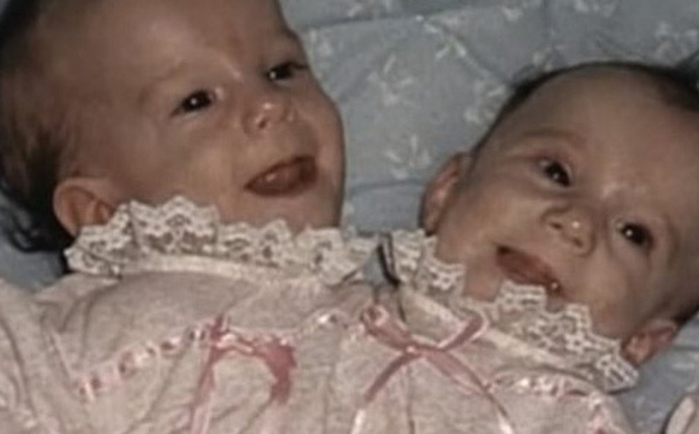 Bị chẩn đoán khó sống sót, cặp chị em sinh đôi dính liền chỉ có 2 chân khiến thế giới kinh ngạc với cuộc sống và diện mạo sau hơn 30 năm