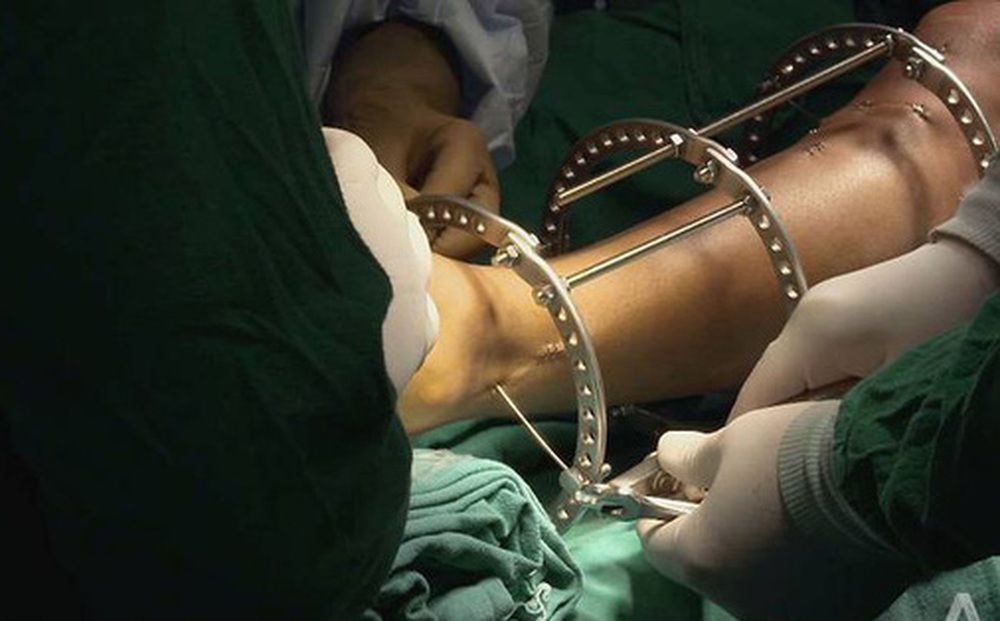 Đập xương kéo chân: Phương pháp phẫu thuật thẩm mỹ kinh dị đột nhiên thành “hot trend” ở Ấn Độ và hậu quả kinh hoàng phía sau