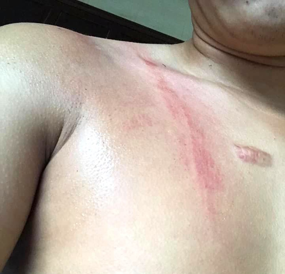 Nam thanh niên thoát chết hy hữu khi bị sét đánh trúng người - Ảnh 2.