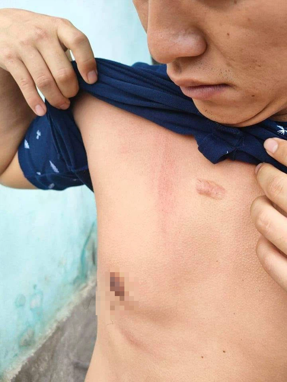 Nam thanh niên thoát chết hy hữu khi bị sét đánh trúng người - Ảnh 1.