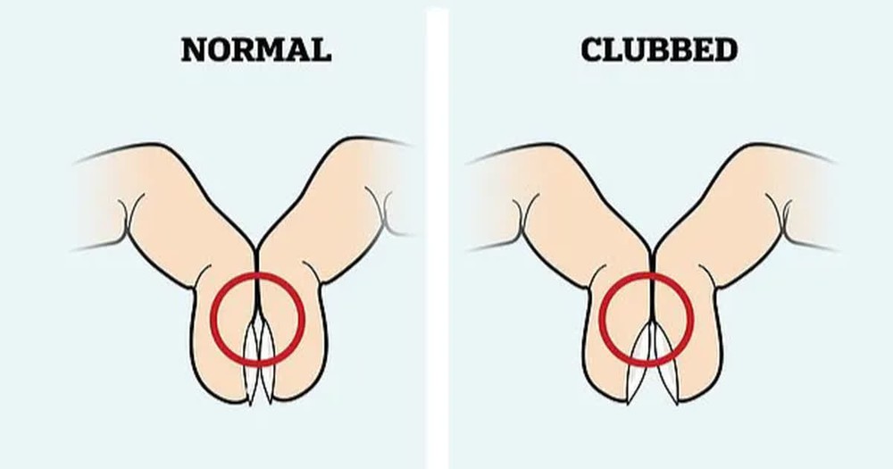 Có dấu hiệu này ở tay, coi chừng nhóm bệnh nguy hiểm có tỷ lệ tử vong hàng đầu - Ảnh 2.