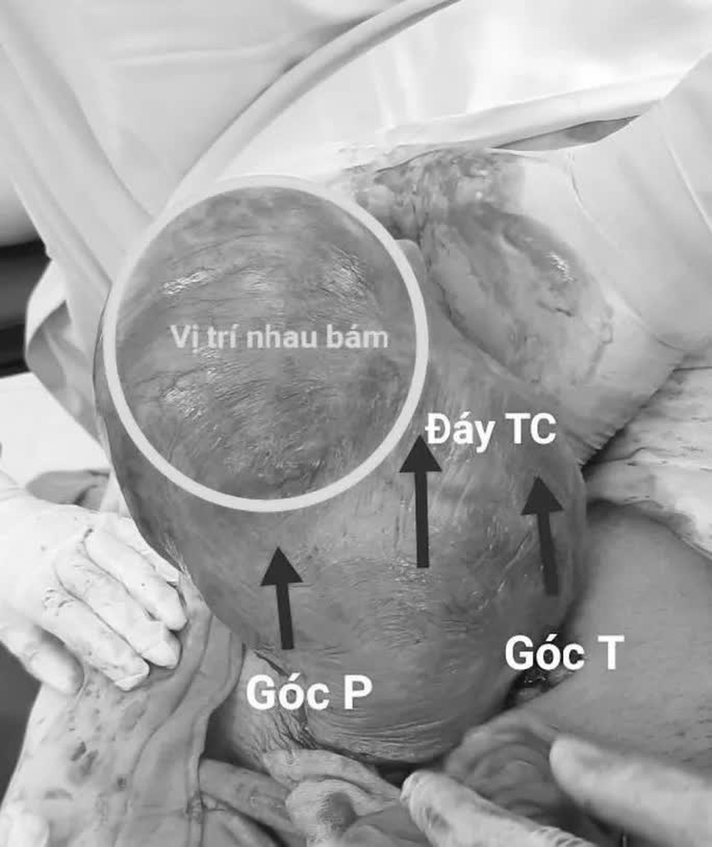 Cứu sống sản phụ mang thai ở góc tử cung hiếm gặp