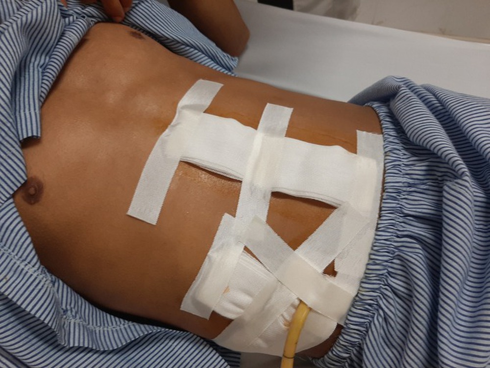 Hai thanh niên bị đâm thủng ruột nguy kịch