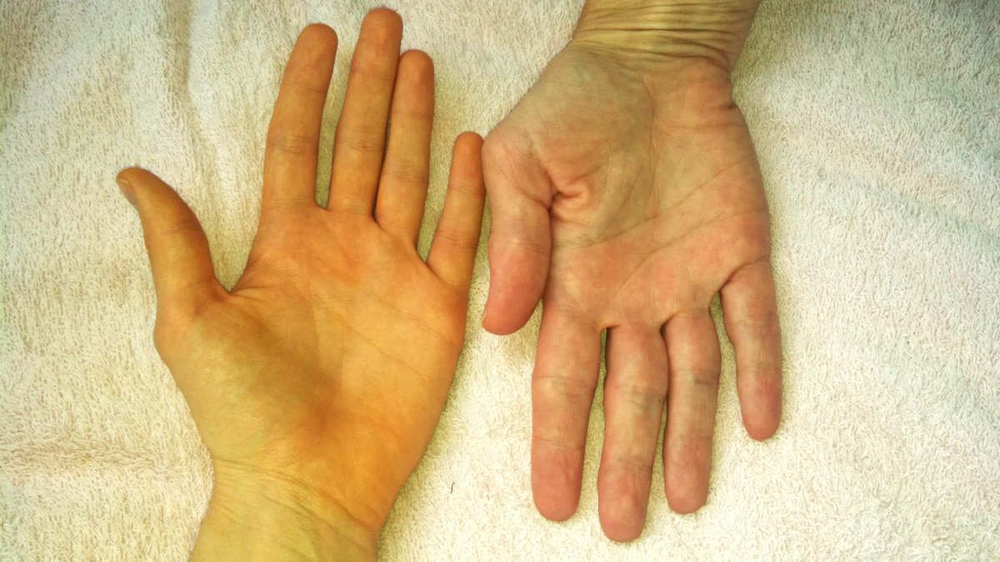 Sau Tết, gan dễ bị tổn thương, gây bệnh nguy hiểm: Dấu hiệu cảnh báo sớm cần đi khám ngay - Ảnh 2.