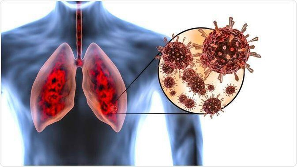 Khó thở dai dẳng là dấu hiệu tổn thương phổi ở bệnh nhân mắc COVID-19 - Ảnh 3.