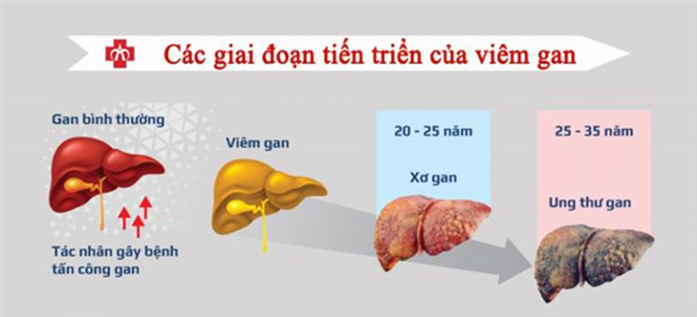 Cách phòng tránh ung thư gan - Ảnh 1.