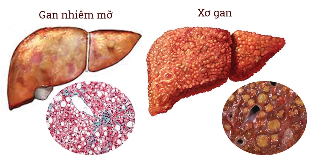Coi chừng gan nhiễm mỡ có thể gây xơ gan, ung thư gan - Ảnh 1.