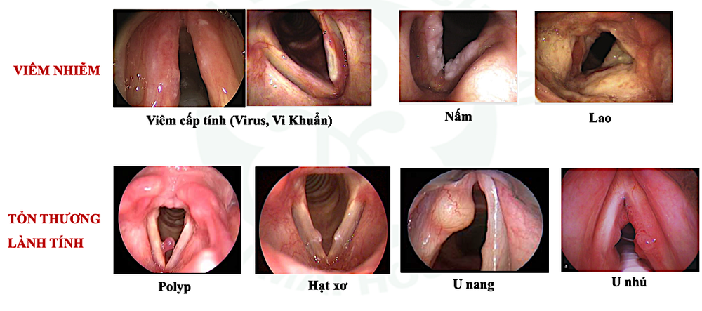 Bất ngờ thay đổi giọng n&oacute;i coi chừng khối u &aacute;c t&iacute;nh thanh quản, u n&atilde;o - Ảnh 1.