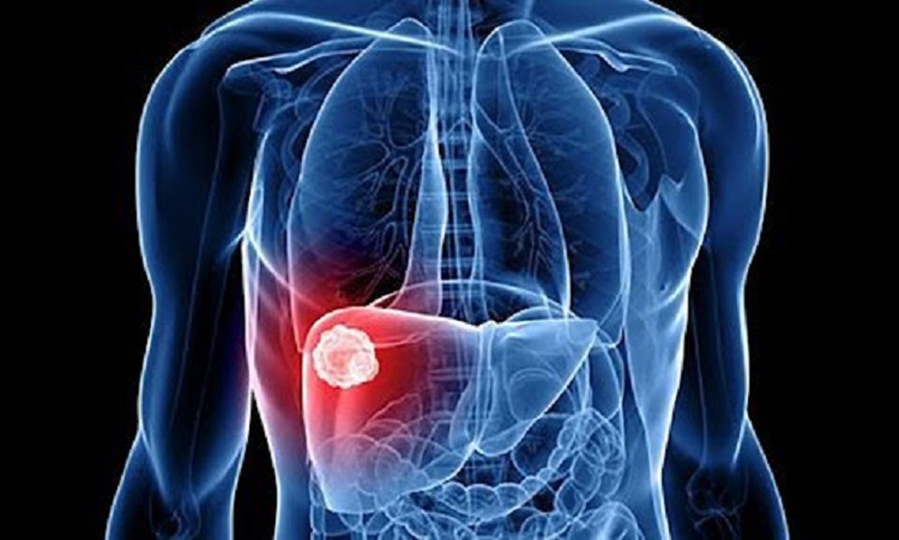 20 years old discovered liver cancer: What experts advise to avoid near-death disease?  - Photo 1.