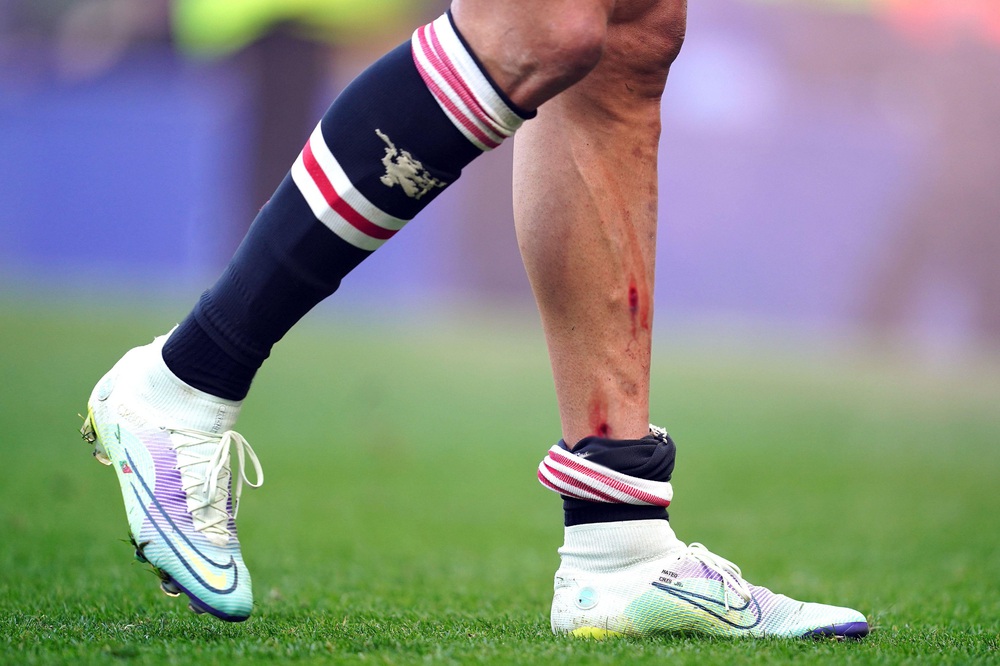 Ronaldo rách chân, đổ máu ở trận thua bạc nhược của MU - Ảnh 1.