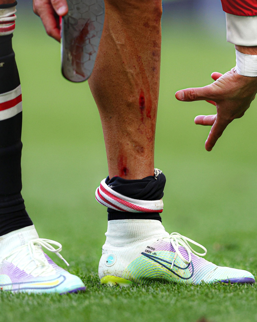 Ronaldo rách chân, đổ máu ở trận thua bạc nhược của MU - Ảnh 2.