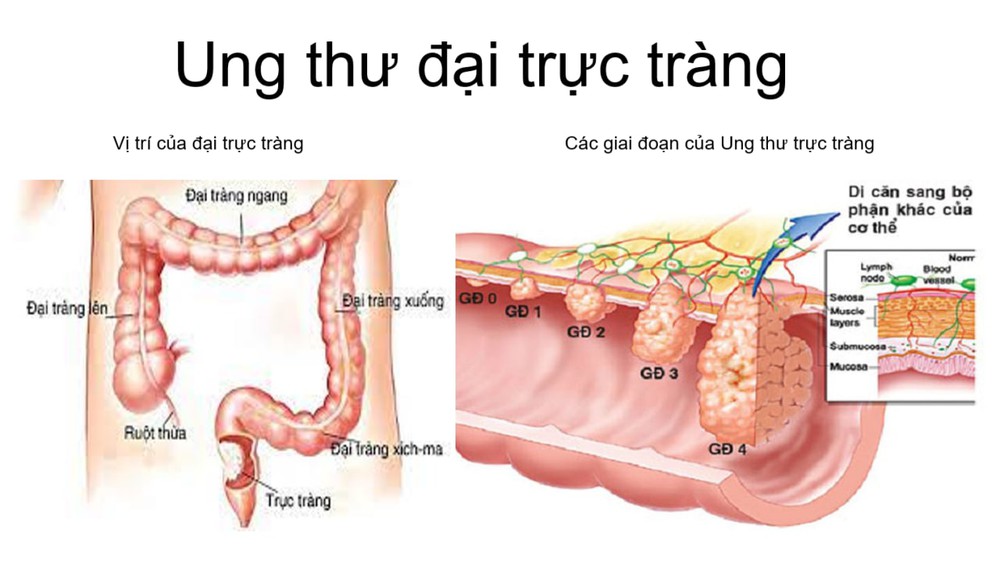 Nhóm bệnh ung thư đang gia tăng: Bác sĩ người Việt tại Nhật chỉ 5 bước phòng ngừa hiệu quả - Ảnh 3.