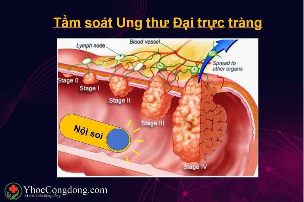 Nhóm bệnh ung thư đang gia tăng: Bác sĩ người Việt tại Nhật chỉ 5 bước phòng ngừa hiệu quả - Ảnh 6.