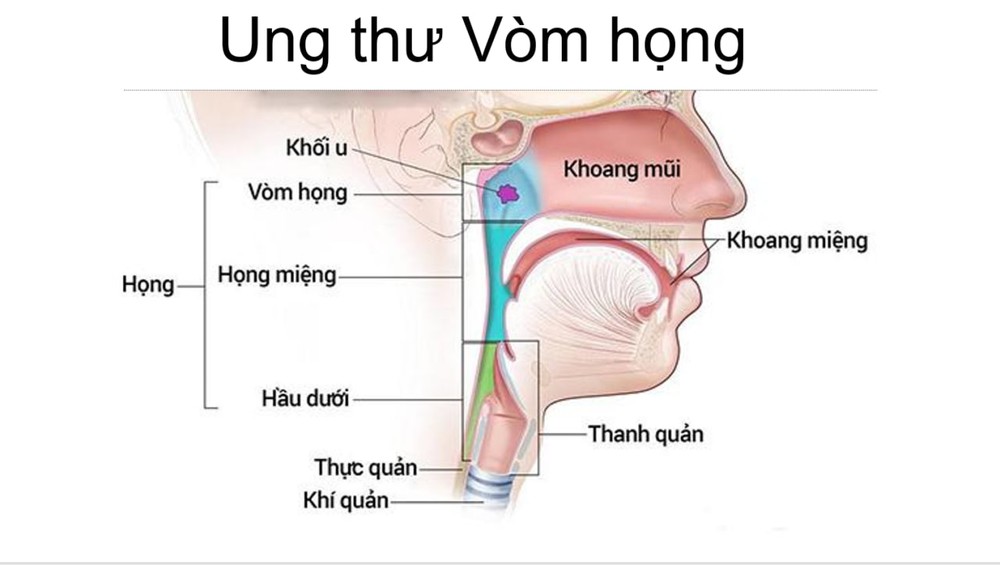 Nhóm bệnh ung thư đang gia tăng: Bác sĩ người Việt tại Nhật chỉ 5 bước phòng ngừa hiệu quả - Ảnh 4.