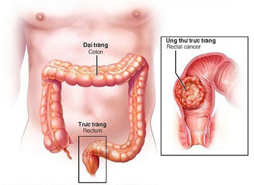Colorectal cancer: Who is susceptible, how to prevent?  - Photo 3.