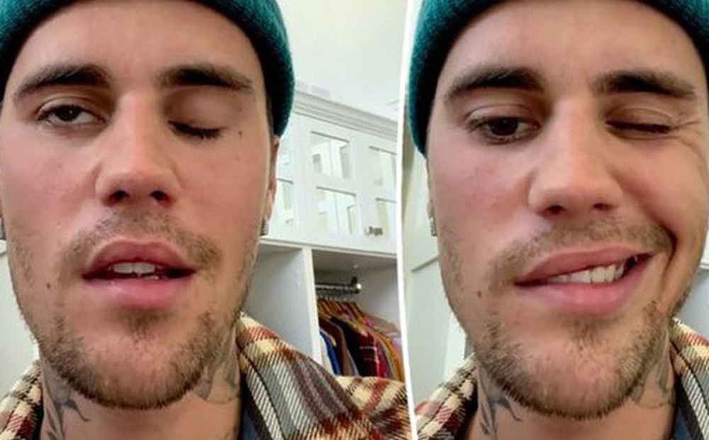 Justin Bieber is very scared and worried about the side effects of the syndrome that causes hemifacial paralysis