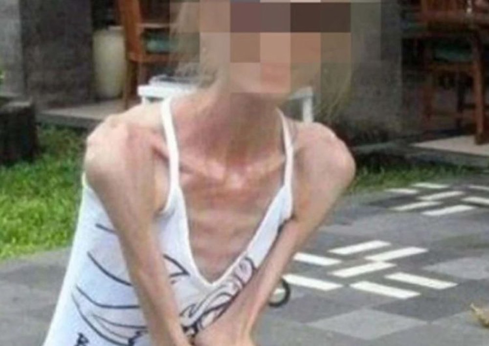 Người phụ nữ Trung Quốc mắc chứng biếng ăn tâm thần sau khi giảm 40kg trong 1 năm - Ảnh 1.