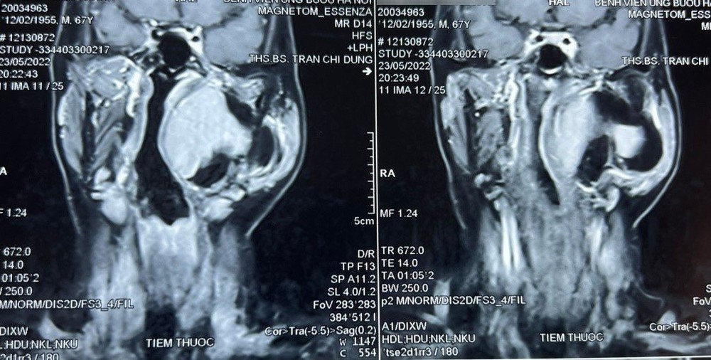 Sưng phồng vùng mang tai, nam bệnh nhân không ngờ mắc khối u hiếm gặp, phức tạp vùng đầu cổ - Ảnh 1.