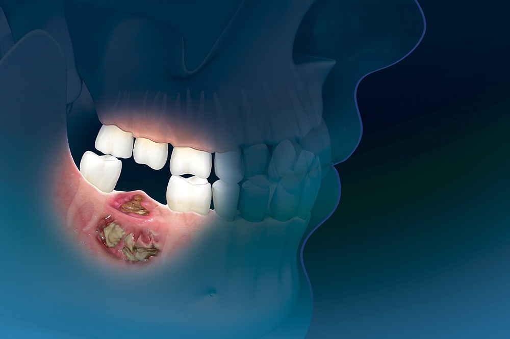 Hoại tử xương sau khi mắc COVID-19: Đừng quá lo vì những chuyện quá hiếm - Ảnh 1.