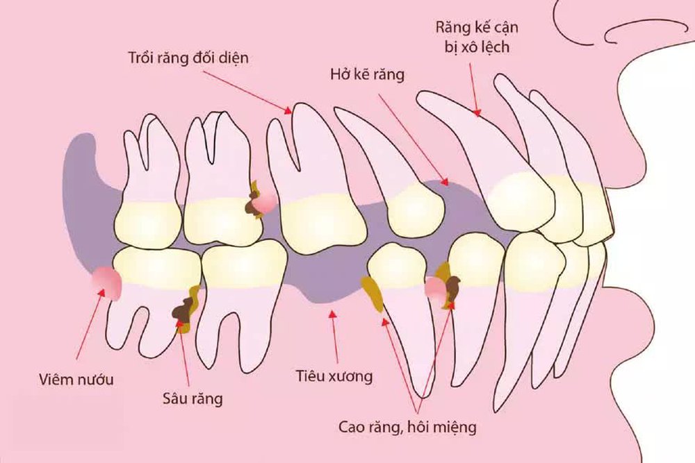 Tiêu xương và hoại tử xương hàm mặt: Chữa càng sớm càng ít nguy biến - Ảnh 2.