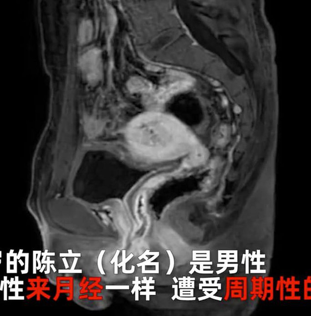  Trung Quốc: Người đàn ông có buồng trứng, tử cung và kinh nguyệt  - Ảnh 2.