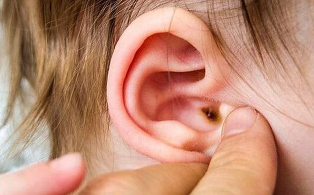 Biến chứng đáng sợ của viêm tai giữa và cách phòng tránh từ chuyên gia