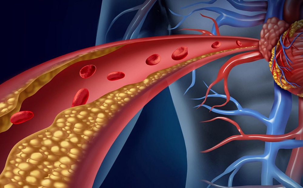 Bác sĩ tim mạch Mỹ: Dấu hiệu cảnh báo lượng cholesterol tăng cao, có một cũng cần đi khám ngay