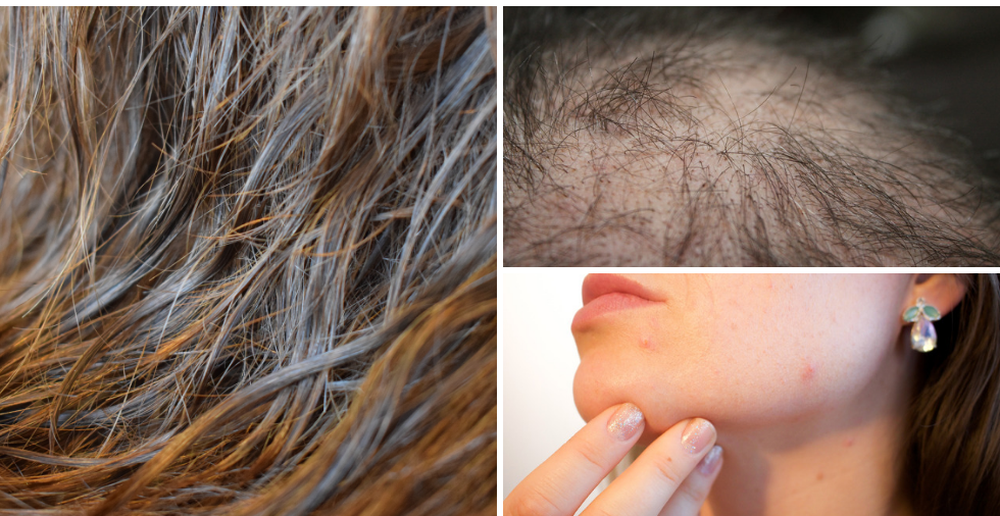 Chuyên gia cảnh báo thói quen làm tăng nguy cơ rụng tóc, khiến vi khuẩn phát triển - Ảnh 1.