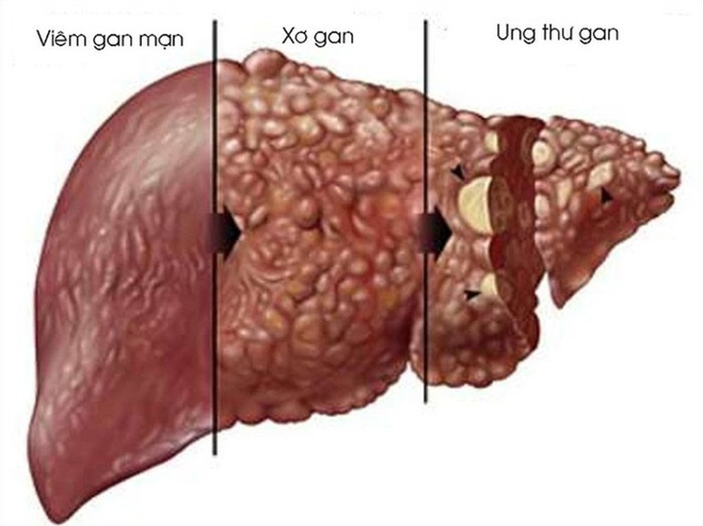 Bác sĩ  đưa bí kíp bảo vệ lá gan ngày Tết - Ảnh 1.