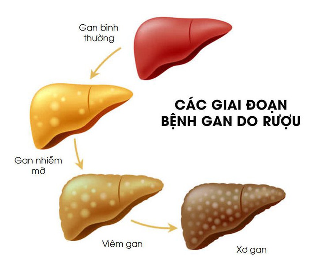 Uống rượu nôn ra máu là bệnh gì? - Ảnh 2.