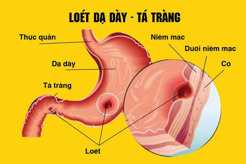 Uống rượu nôn ra máu là bệnh gì? - Ảnh 1.