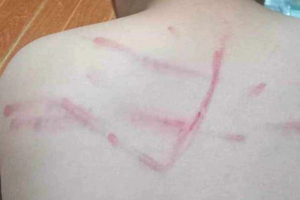 Không làm bài tập, học sinh lớp 4 ở Thanh Hóa bị cô giáo đánh lằn lưng - Ảnh 1.