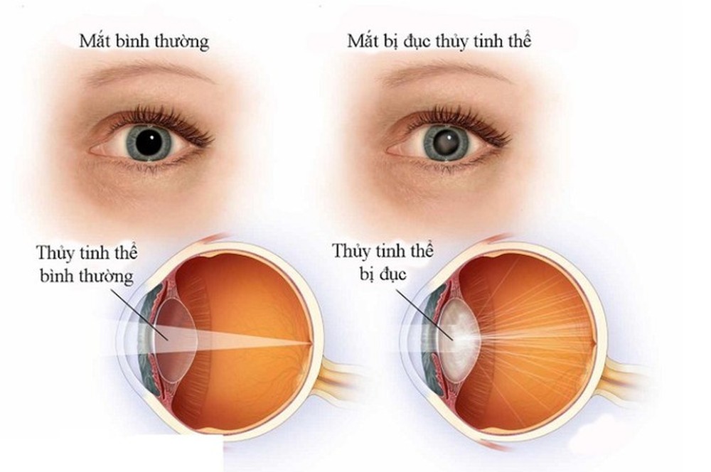 Cô gái 22 tuổi mắc bệnh tiểu đường, biến chứng vào mắt gây đục thủy tinh thể - Ảnh 1.