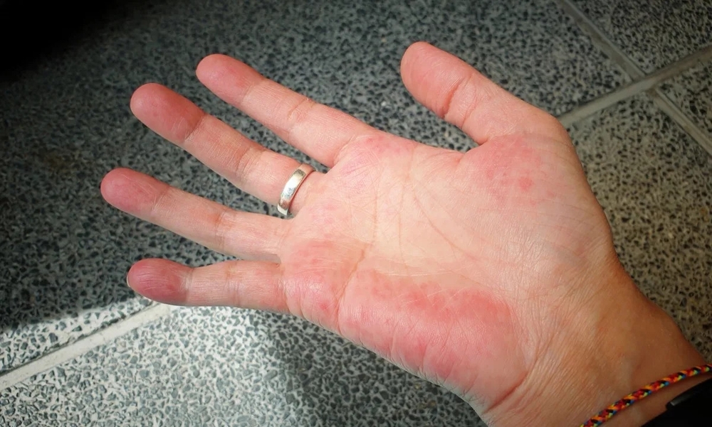 Bàn tay có thể dự báo bệnh tật: 4 dấu hiệu bất thường ở tay cảnh báo tim, gan suy yếu, ung thư ‘tìm đến’ - Ảnh 4.