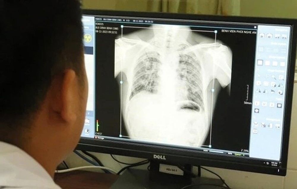 Vụ 6 công nhân tử vong do bụi phổi ở Nghệ An: Thêm 57 người mắc bệnh - Ảnh 2.