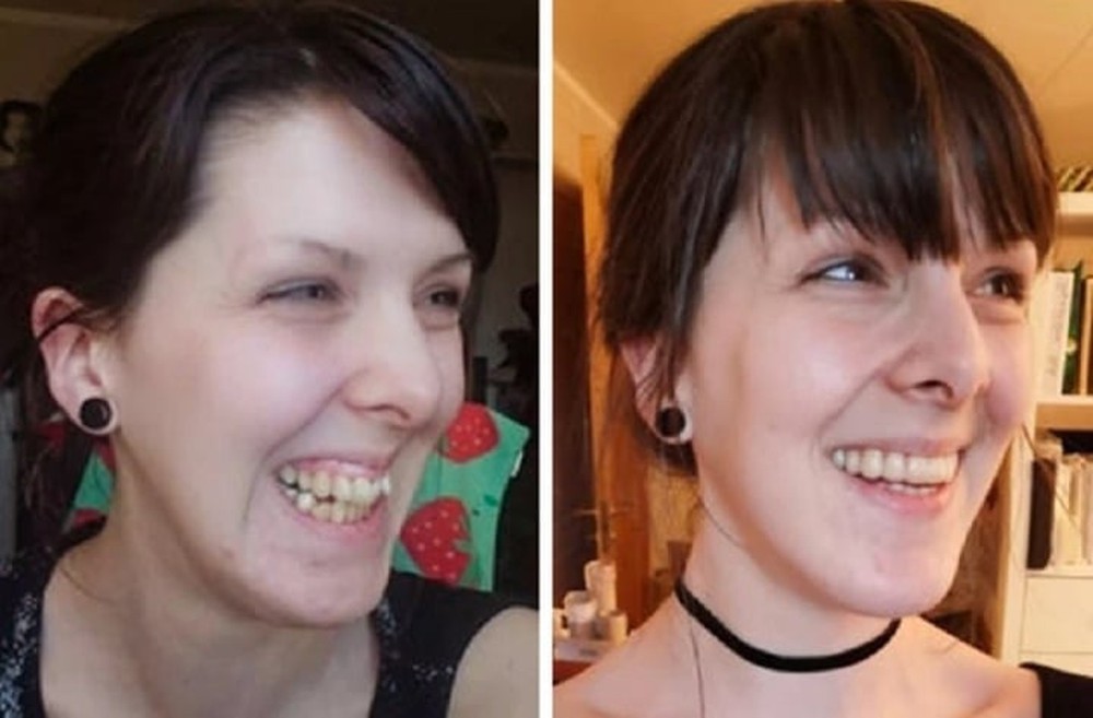 20 bức ảnh chứng minh niềng răng thay đổi nụ cười của bạn ra sao - Ảnh 8.