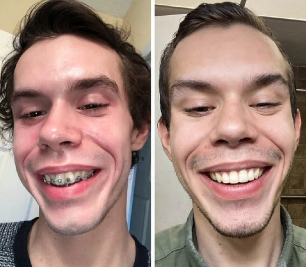 20 bức ảnh chứng minh niềng răng thay đổi nụ cười của bạn ra sao - Ảnh 6.