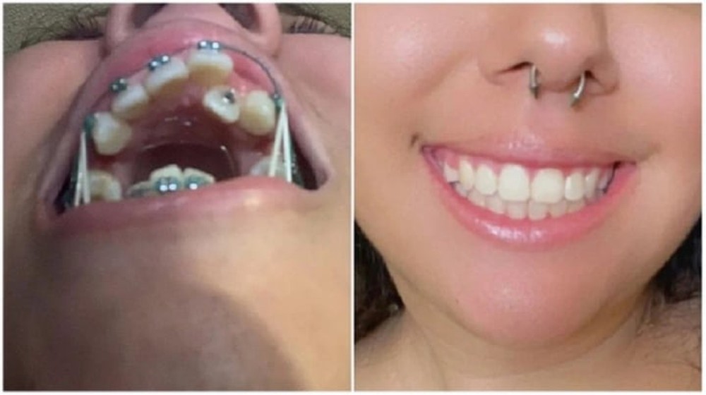 20 bức ảnh chứng minh niềng răng thay đổi nụ cười của bạn ra sao - Ảnh 18.