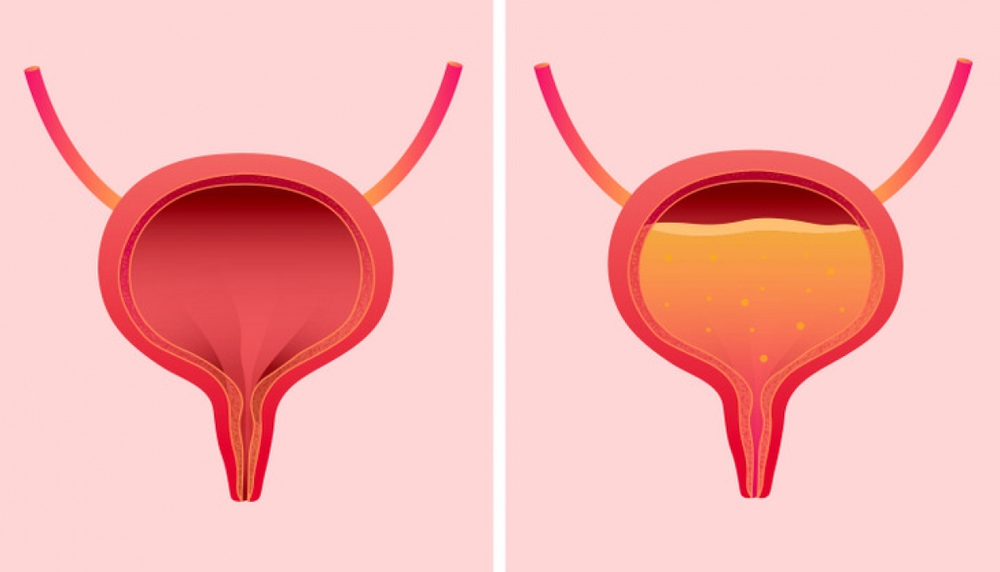 Vì sao không nên nhịn tiểu quá lâu? - Ảnh 1.
