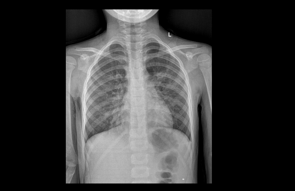 Cảnh báo tình trạng bệnh nhi viêm phổi nặng tăng đột biến: BS chỉ ra dấu hiệu bệnh trở nặng - Ảnh 1.