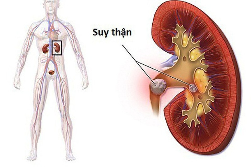 Những triệu chứng suy thận giai đoạn đầu cần chú ý - Ảnh 1.