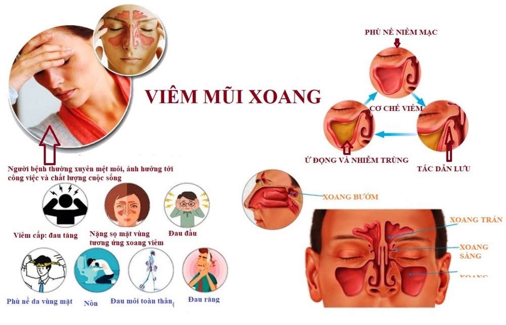 Các thói quen xấu dễ dẫn đến viêm mũi xoang - Ảnh 2.