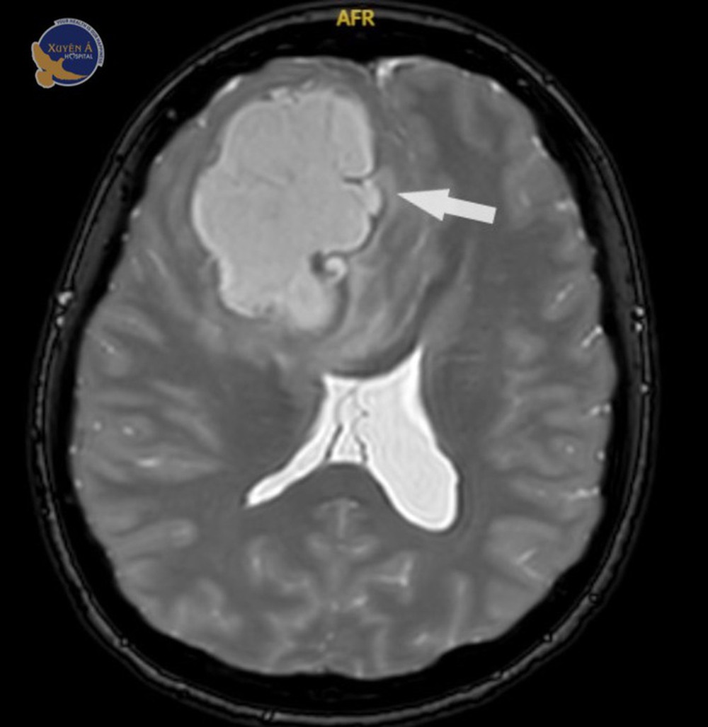 Khối u 5 cm trốn trong não nữ bệnh nhân Campuchia - Ảnh 1.